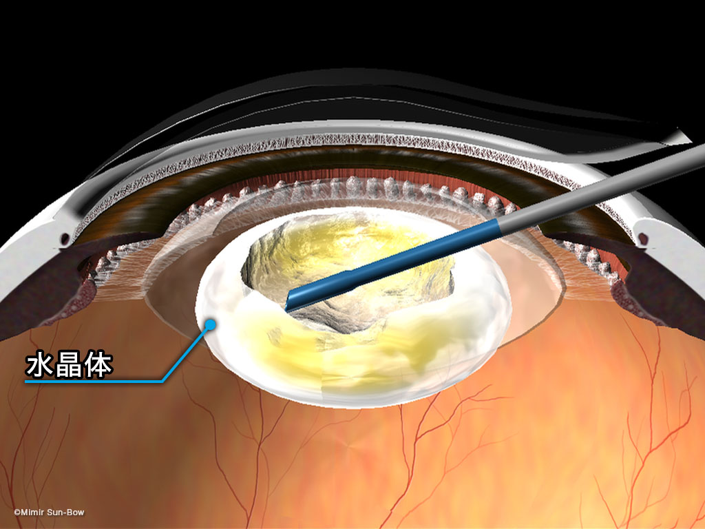 超音波乳化吸引術のイメージ