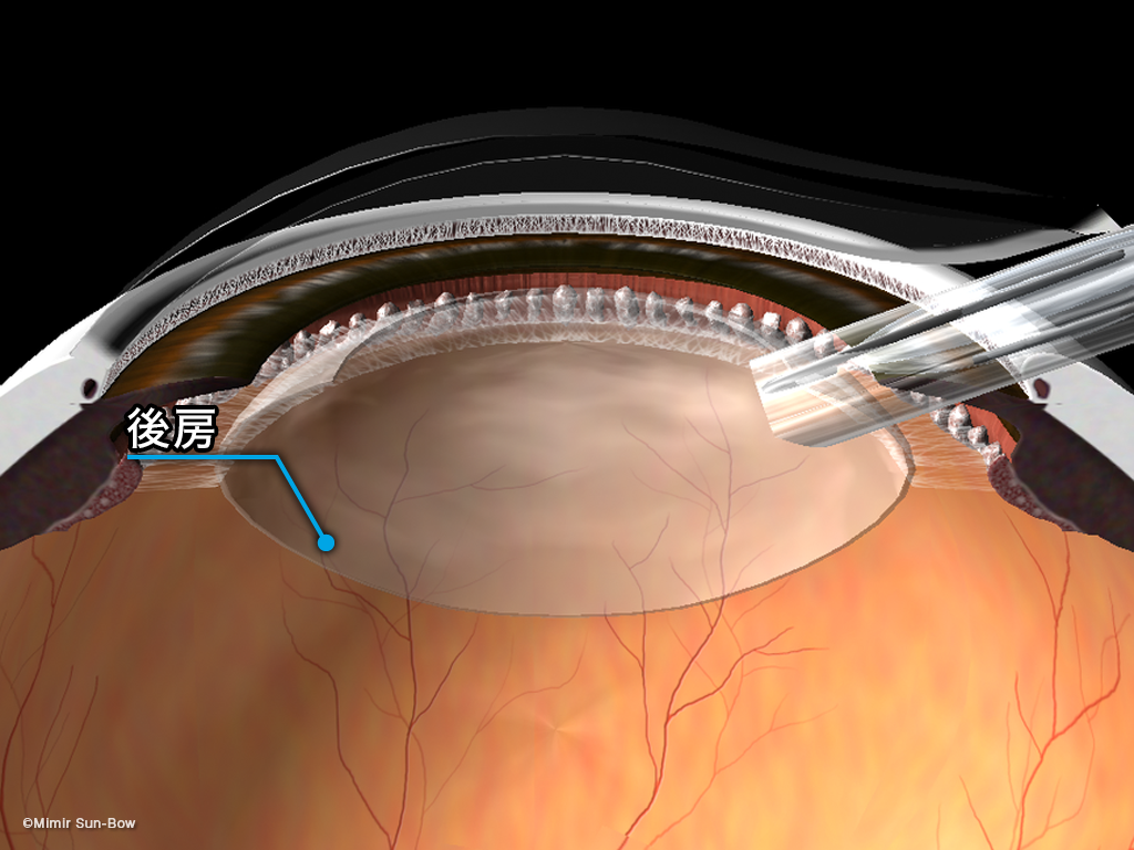 眼内レンズのイメージ